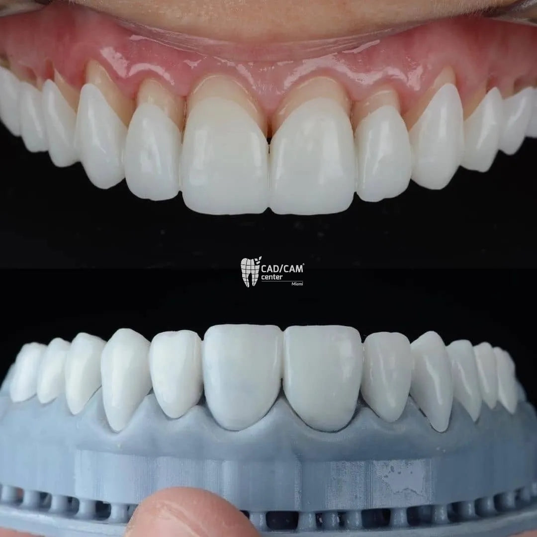 Finished anterior CEREC smile and corresponding restoration model