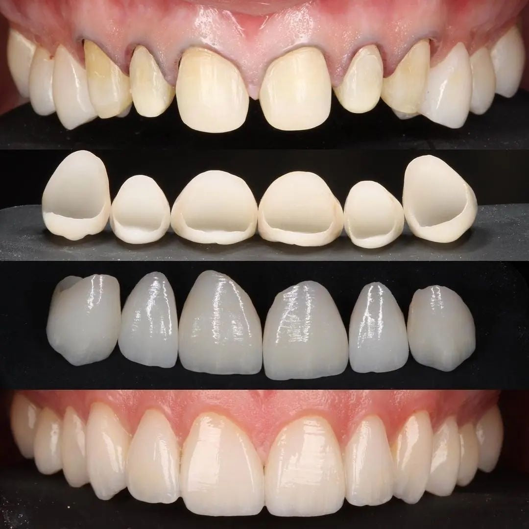 Multi-unit anterior CEREC restoration workflow and finished smile