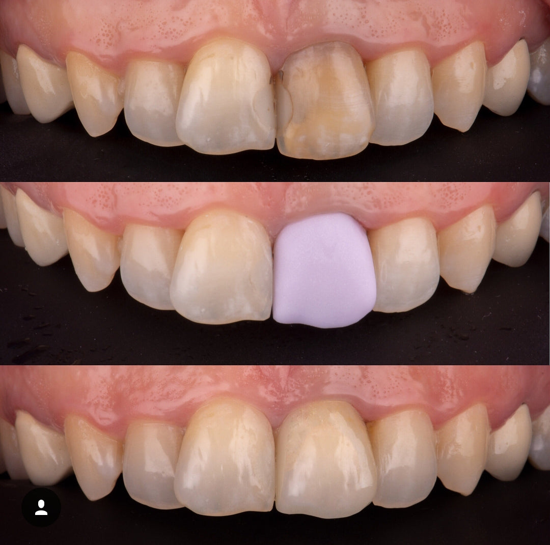 Anterior CEREC restoration showing preparation, design and final result