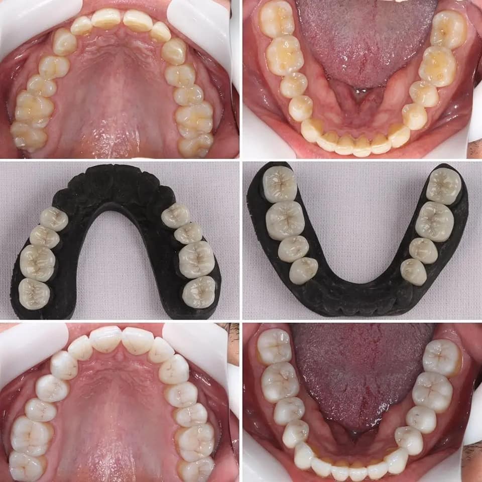 Upper and lower CEREC restorative cases from design through delivery