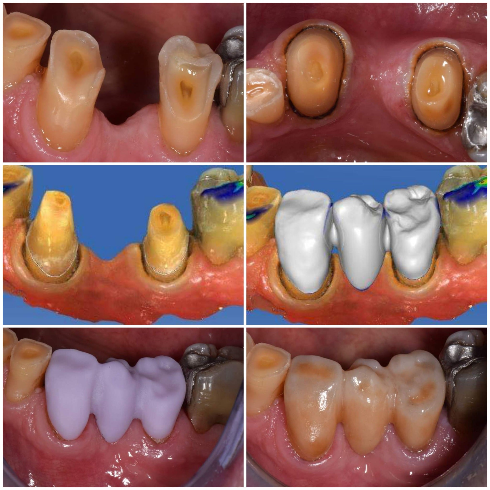Posterior CEREC bridge workflow from preparation through final restoration