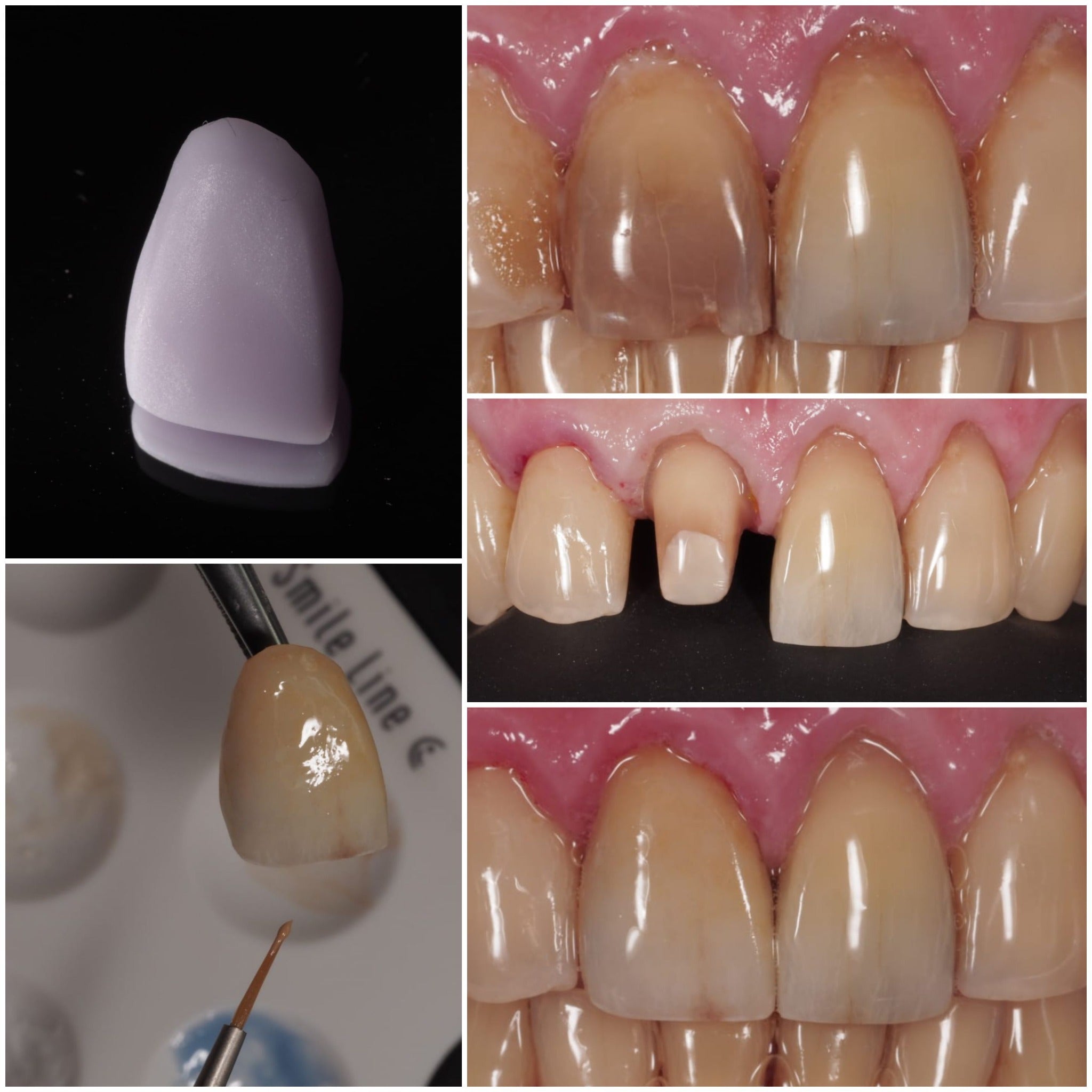 CEREC anterior crown workflow and natural shade match